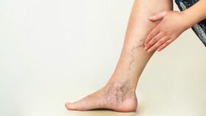 Varicose veins on the womans legs